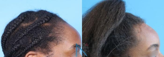 Before & After Forehead Reduction Case 156 View 3 View in Raleigh, NC