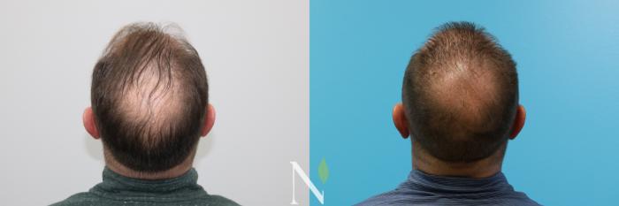 Before & After Hair Restoration Case 189 Back View in Raleigh, NC