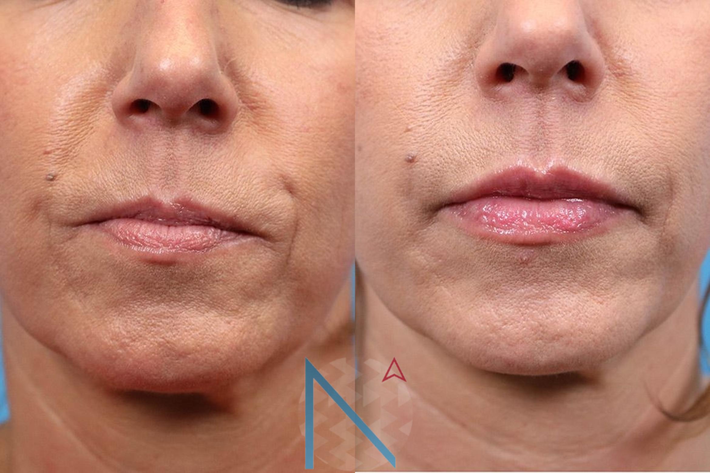 Before & After Injectables & Fillers Case 176 Front View in Raleigh, NC