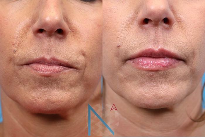 Before & After Injectables & Fillers Case 176 Front View in Raleigh, NC