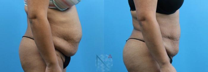 Before & After Lipo 360 Case 132 View 3 View in Raleigh, NC