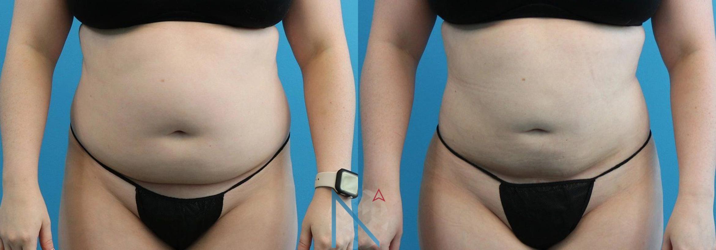 Before & After Lipo 360 Case 133 View 1 View in Raleigh, NC