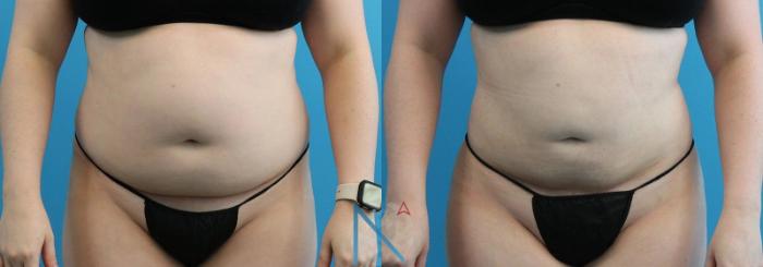 Before & After Lipo 360 Case 133 View 1 View in Raleigh, NC