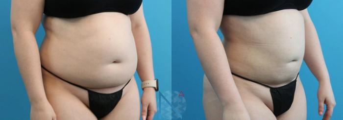 Before & After Lipo 360 Case 133 View 2 View in Raleigh, NC