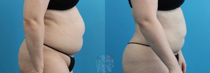 Before & After Lipo 360 Case 133 View 3 View in Raleigh, NC