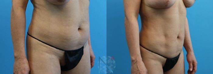 Before & After Lipo 360 Case 134 View 2 View in Raleigh, NC