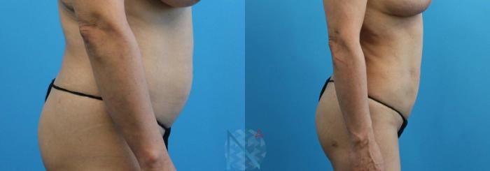 Before & After Lipo 360 Case 134 View 3 View in Raleigh, NC