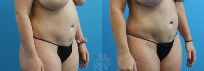 Before & After Lipo 360 Case 135 View 2 View in Raleigh, NC