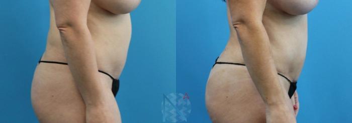 Before & After Lipo 360 Case 135 View 3 View in Raleigh, NC