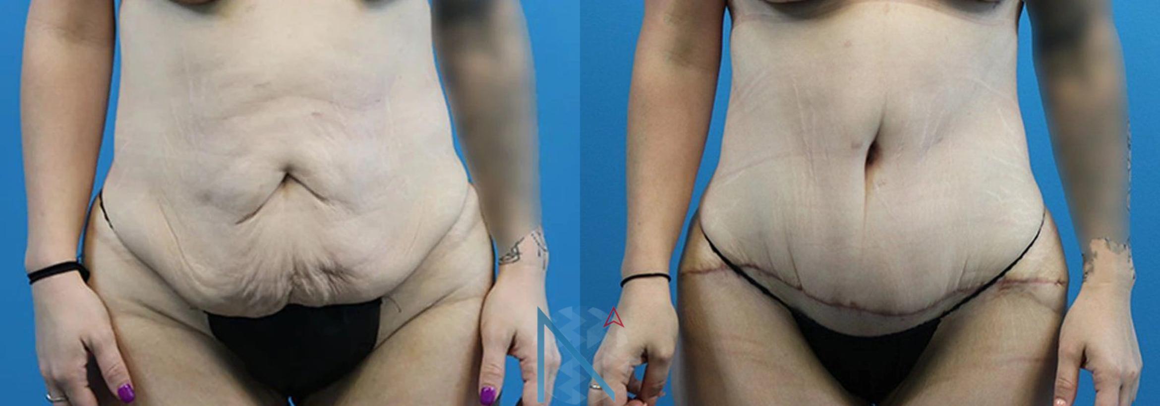 Before & After Lipo 360 Case 136 View 1 View in Raleigh, NC