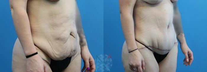 Before & After Lipo 360 Case 136 View 2 View in Raleigh, NC