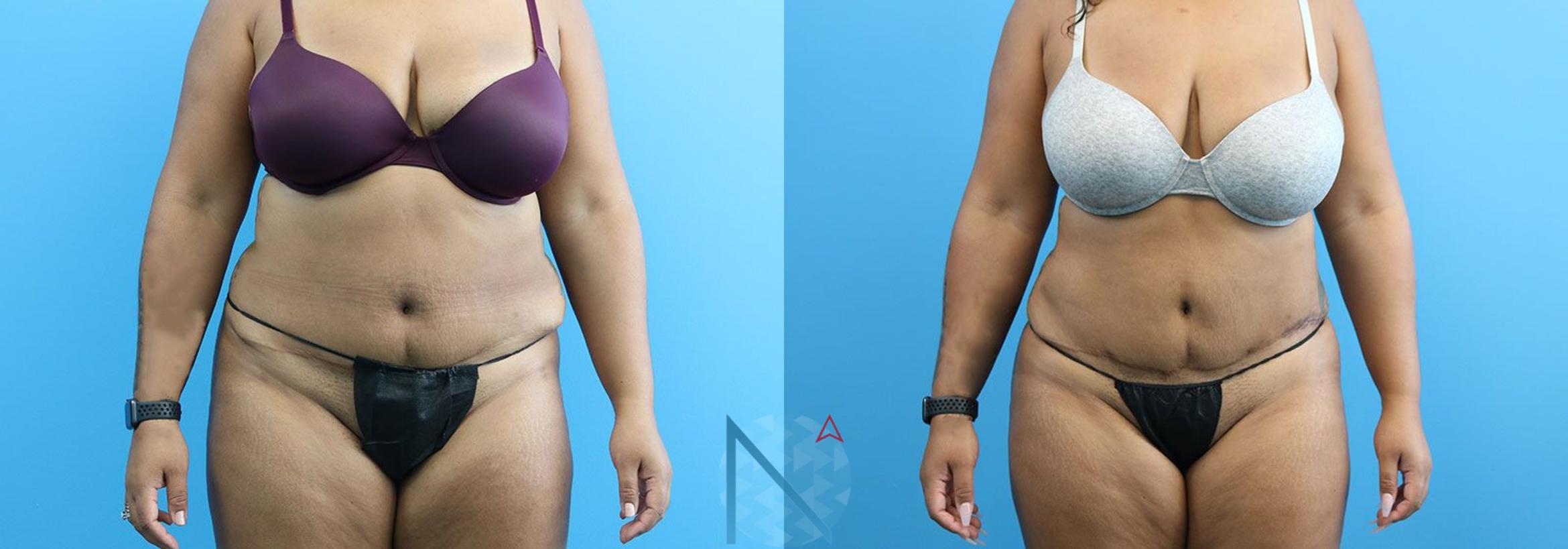 Before & After Lipo 360 Case 137 View 1 View in Raleigh, NC