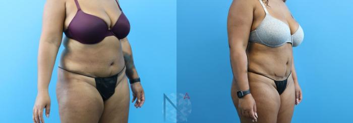 Before & After Lipo 360 Case 137 View 2 View in Raleigh, NC