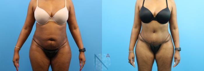 Before & After Lipo 360 Case 138 View 1 View in Raleigh, NC