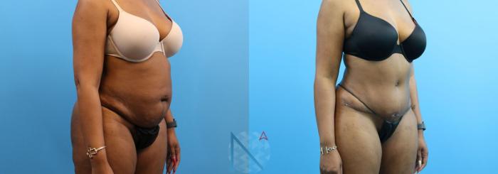 Before & After Lipo 360 Case 138 View 2 View in Raleigh, NC