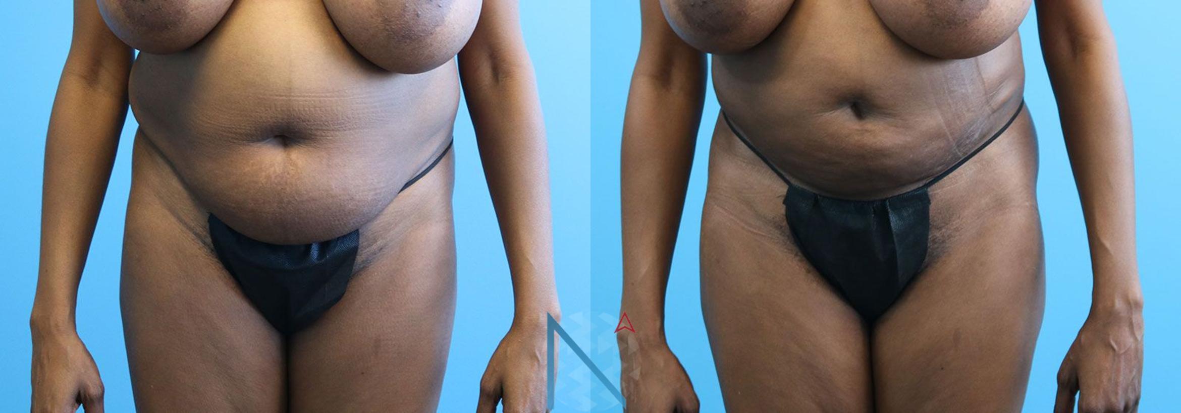 Before & After Lipo 360 Case 139 View 1 View in Raleigh, NC