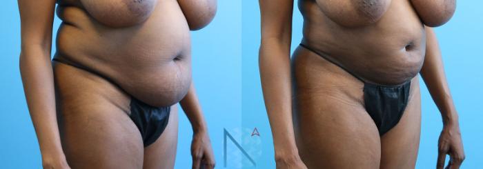 Before & After Lipo 360 Case 139 View 2 View in Raleigh, NC