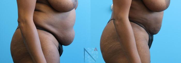 Before & After Lipo 360 Case 139 View 3 View in Raleigh, NC