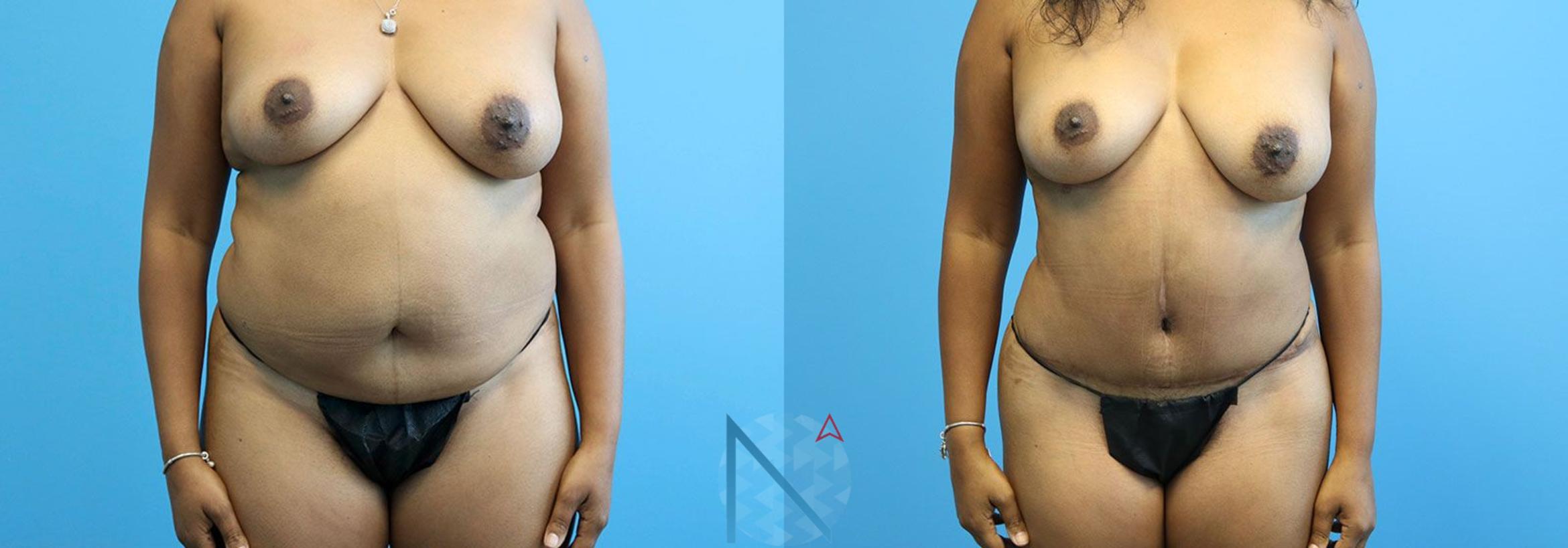 Before & After Lipo 360 Case 140 View 1 View in Raleigh, NC