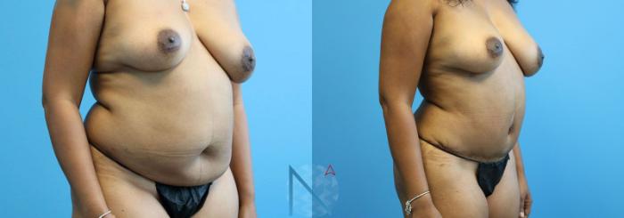 Before & After Lipo 360 Case 140 View 2 View in Raleigh, NC