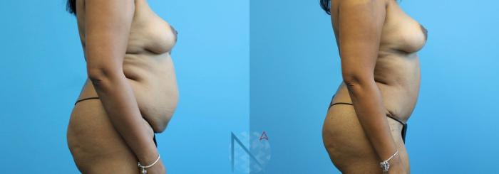 Before & After Lipo 360 Case 140 View 3 View in Raleigh, NC