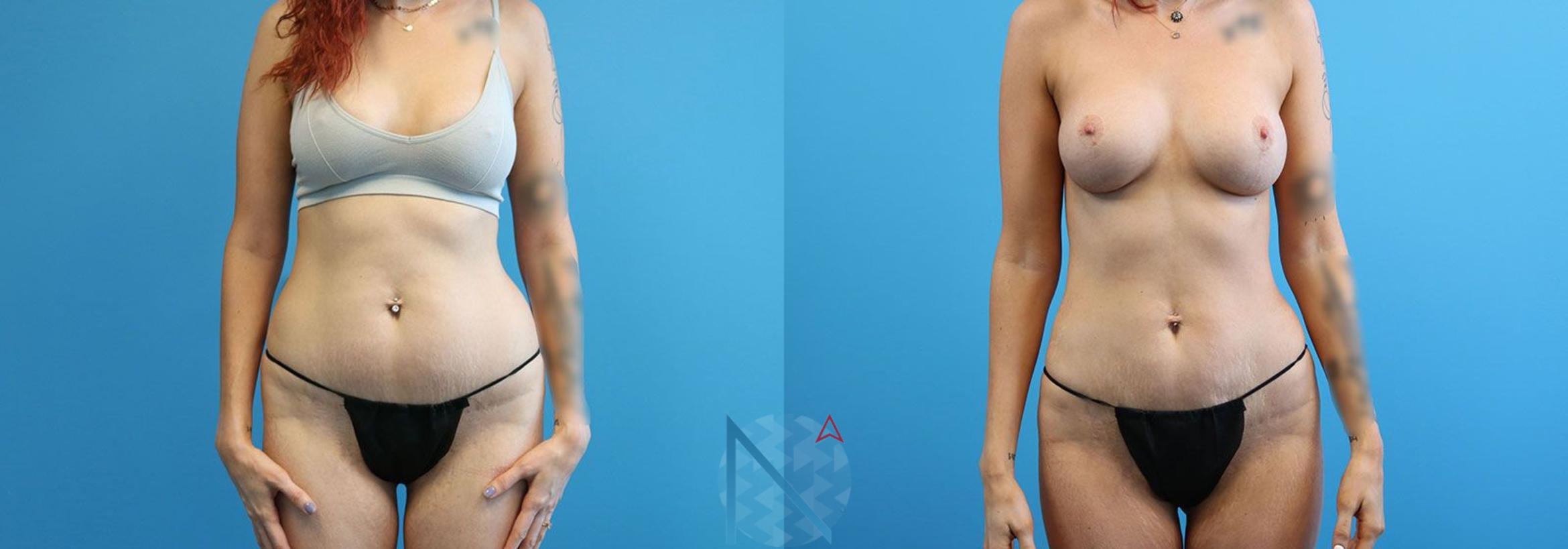 Before & After Lipo 360 Case 141 View 1 View in Raleigh, NC