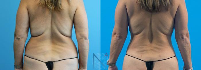 Before & After Lipo 360 Case 142 View 1 View in Raleigh, NC