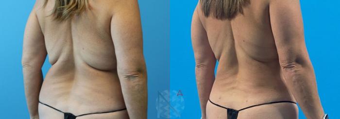 Before & After Lipo 360 Case 142 View 2 View in Raleigh, NC