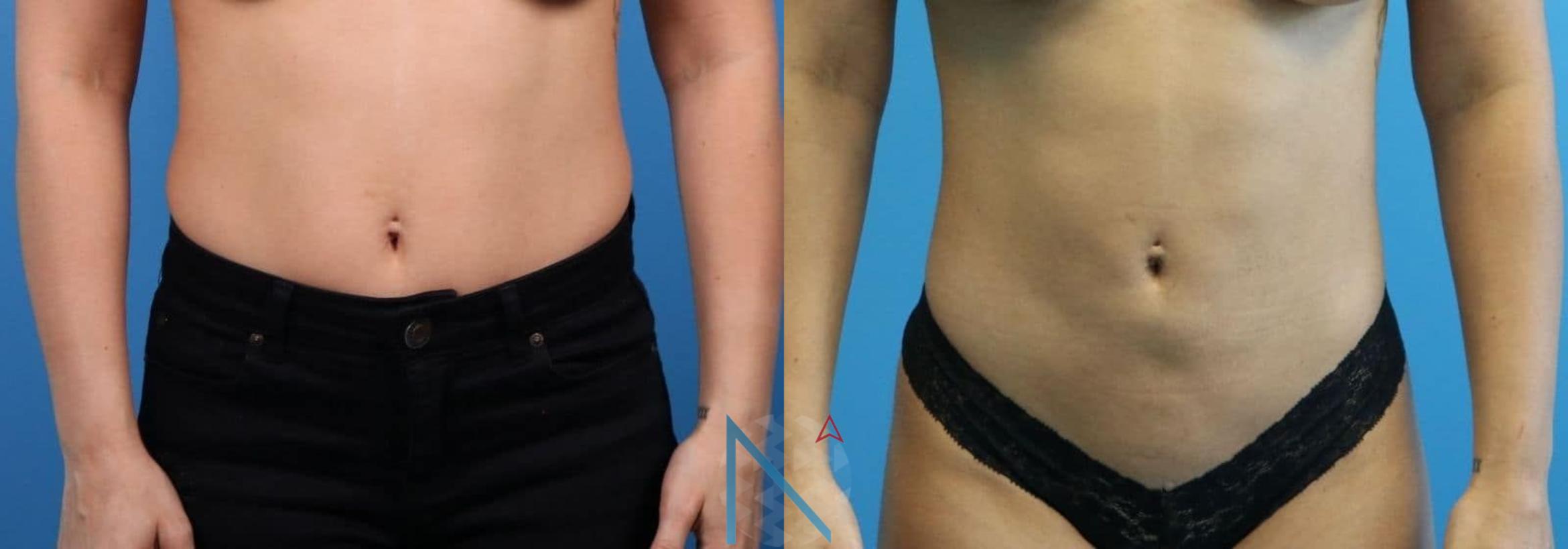 Before & After Lipo 360 Case 143 View 1 View in Raleigh, NC