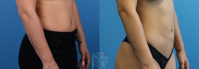 Before & After Lipo 360 Case 143 View 2 View in Raleigh, NC