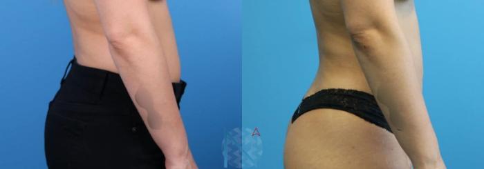 Before & After Lipo 360 Case 143 View 3 View in Raleigh, NC