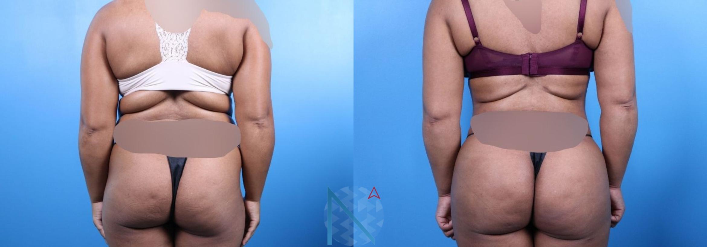 Before & After Lipo 360 Case 144 View 1 View in Raleigh, NC