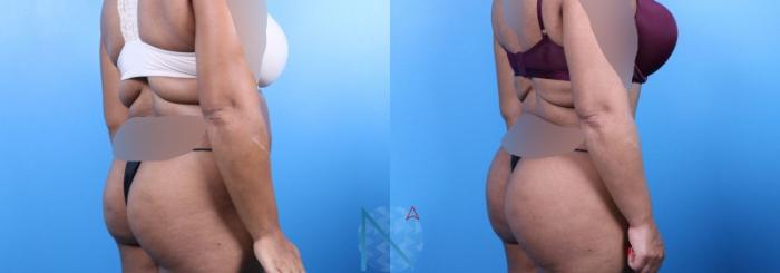 Before & After Lipo 360 Case 144 View 2 View in Raleigh, NC