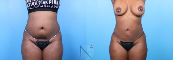 Before & After Lipo 360 Case 145 View 1 View in Raleigh, NC