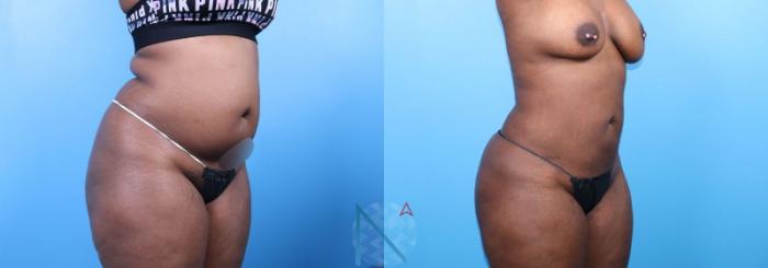 Before & After Lipo 360 Case 145 View 2 View in Raleigh, NC