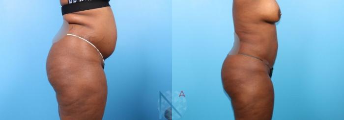 Before & After Lipo 360 Case 145 View 3 View in Raleigh, NC