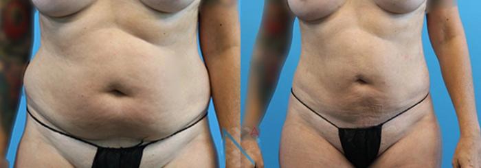 Before & After Liposuction Case 105 View 1 View in Raleigh, NC