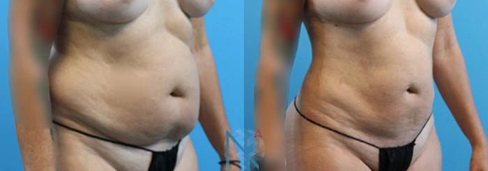 Before & After Liposuction Case 105 View 2 View in Raleigh, NC