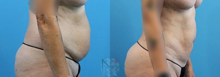 Before & After Liposuction Case 105 View 3 View in Raleigh, NC