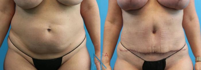 Before & After Liposuction Case 106 View 1 View in Raleigh, NC