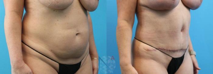 Before & After Liposuction Case 106 View 2 View in Raleigh, NC