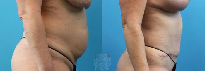 Before & After Liposuction Case 106 View 3 View in Raleigh, NC