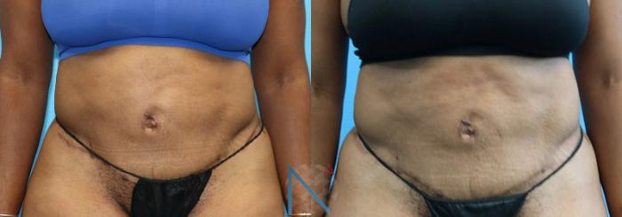 Before & After Liposuction Case 107 View 1 View in Raleigh, NC