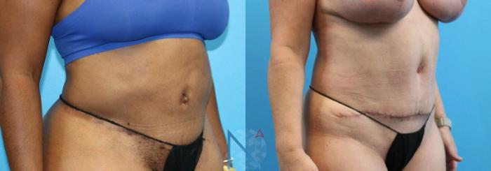 Before & After Liposuction Case 107 View 2 View in Raleigh, NC