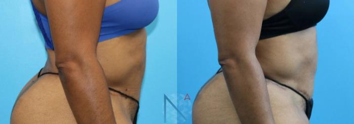 Before & After Liposuction Case 107 View 3 View in Raleigh, NC