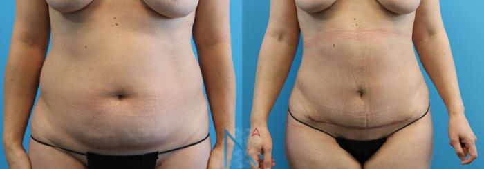 Before & After Liposuction Case 108 View 1 View in Raleigh, NC