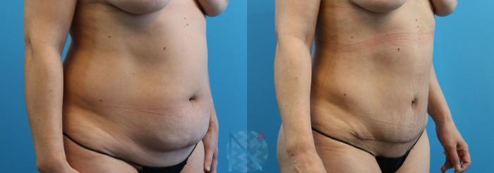 Before & After Liposuction Case 108 View 2 View in Raleigh, NC