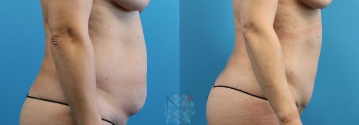 Before & After Liposuction Case 108 View 3 View in Raleigh, NC