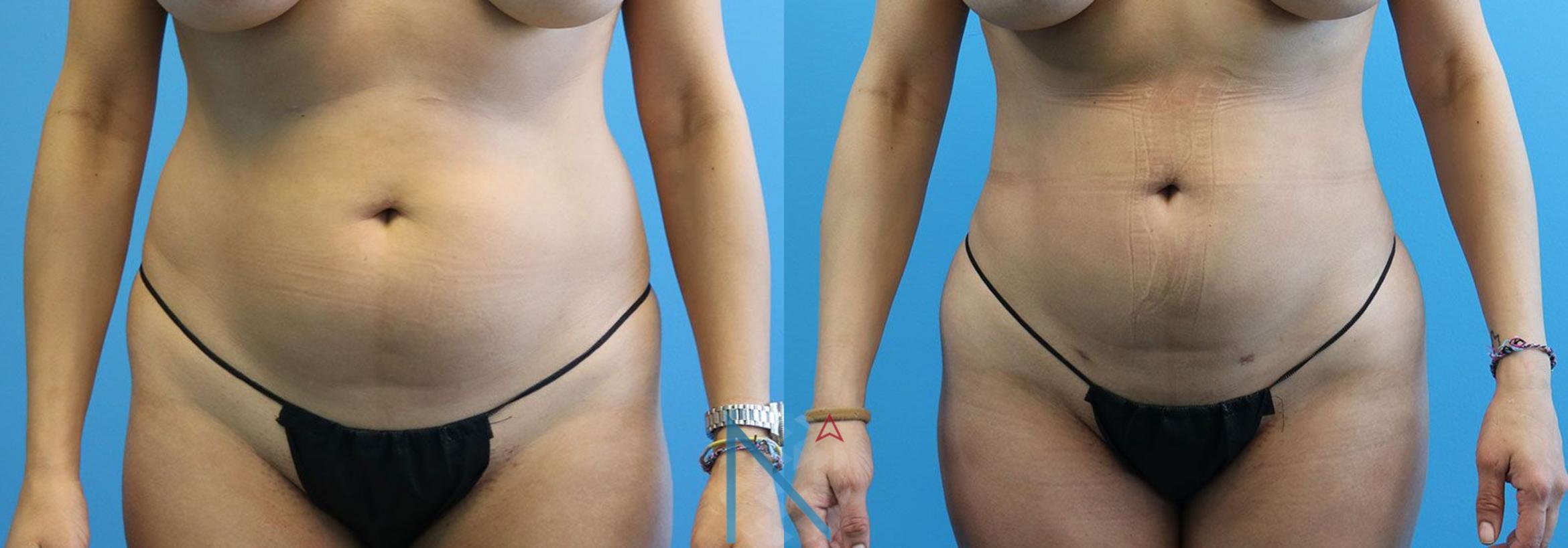 Before & After Liposuction Case 109 View 1 View in Raleigh, NC