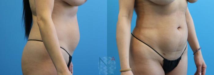 Before & After Liposuction Case 109 View 2 View in Raleigh, NC